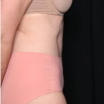 Tummy Tuck Before & After Patient #34348